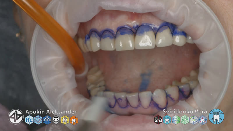 Professinal Dental Hygiene with DTE PT 5 ( FHD