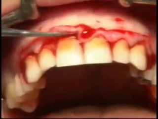 Gingival Surgery - External Bevel. Гингивотомия. Пародонтология