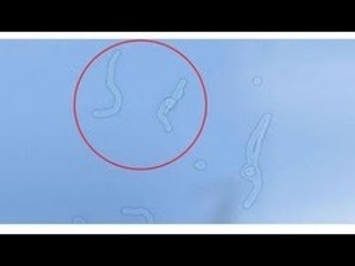 Отчего появляются полупрозрачные мушки перед глазами